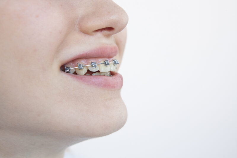 歯 の 矯正 保険 適応