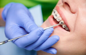 歯科矯正を行う前の虫歯治療
