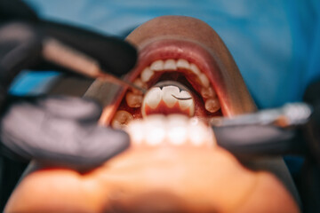 歯科矯正八重歯