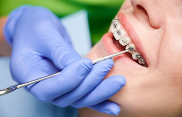 歯科矯正治療中におけるゴムかけについて