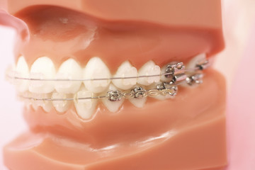 歯科矯正治療のトラブルとは？
