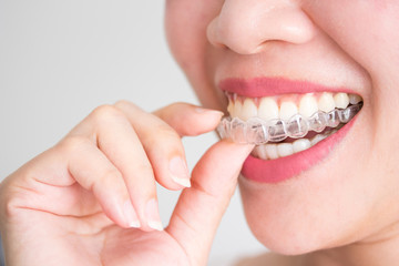 歯列矯正治療におけるリテーナーについて