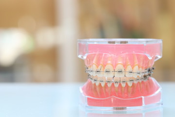 歯列矯正治療のワイヤー装置に関する注意点
