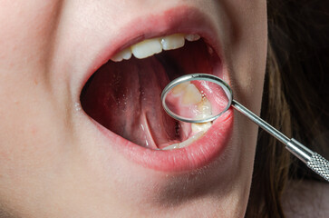 eラインのための歯科矯正治療では、抜歯が必須？