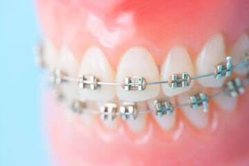 歯科矯正の装置が外れる原因