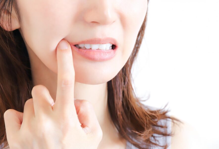 むし歯だらけでも歯列矯正できる？歯列矯正中のむし歯の対処法、予防方法を解説