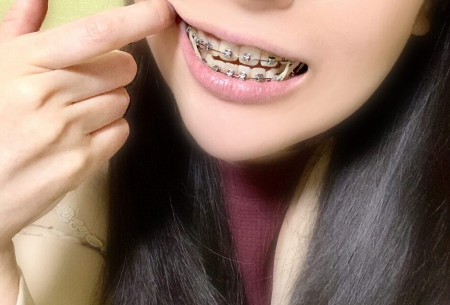 歯列矯正で口の中が傷だらけになった！原因と予防、対処法を解説