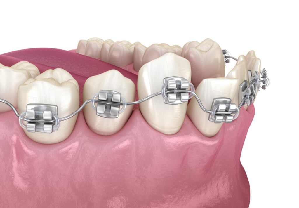 歯列矯正で歯が動く仕組み