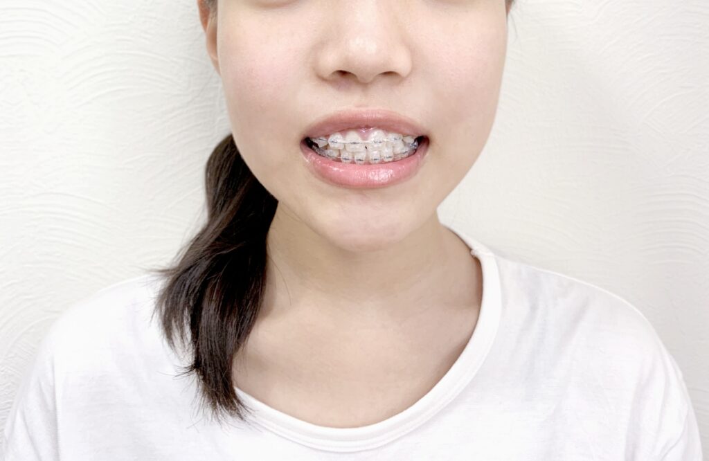 歯科矯正中　歯　女性