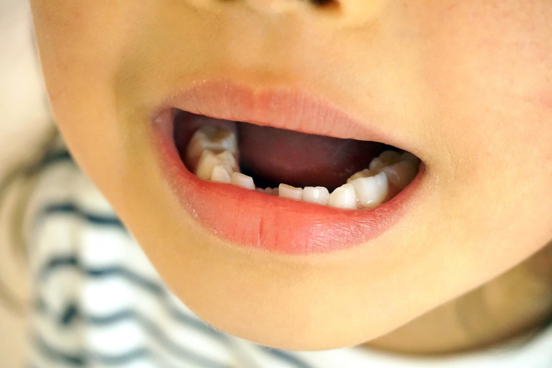 乳歯の歯並びが永久歯に悪影響を及ぼすケース