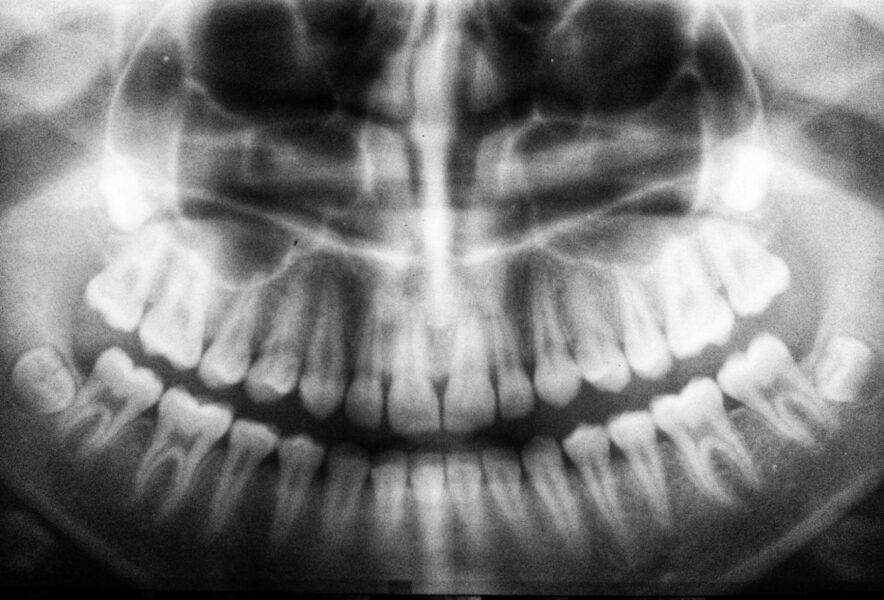 埋伏歯とは？歯が埋まって生えてこない原因や治療法、放置するリスク