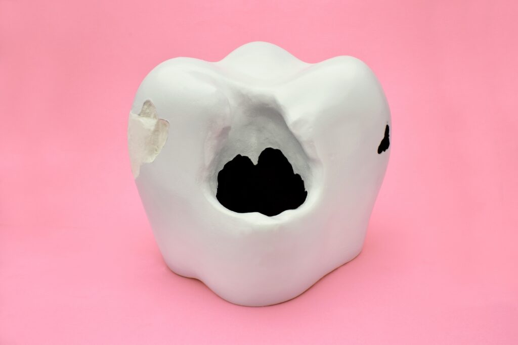 むし歯の模型