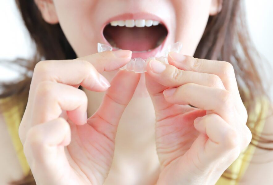 インビザラインで出っ歯は治せる？治療の流れから注意点までを解説！