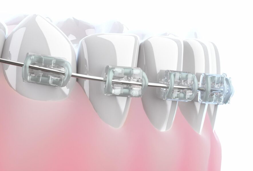 セラミックブラケットとクリアブラケットの違いとは？特徴や選び方を解説