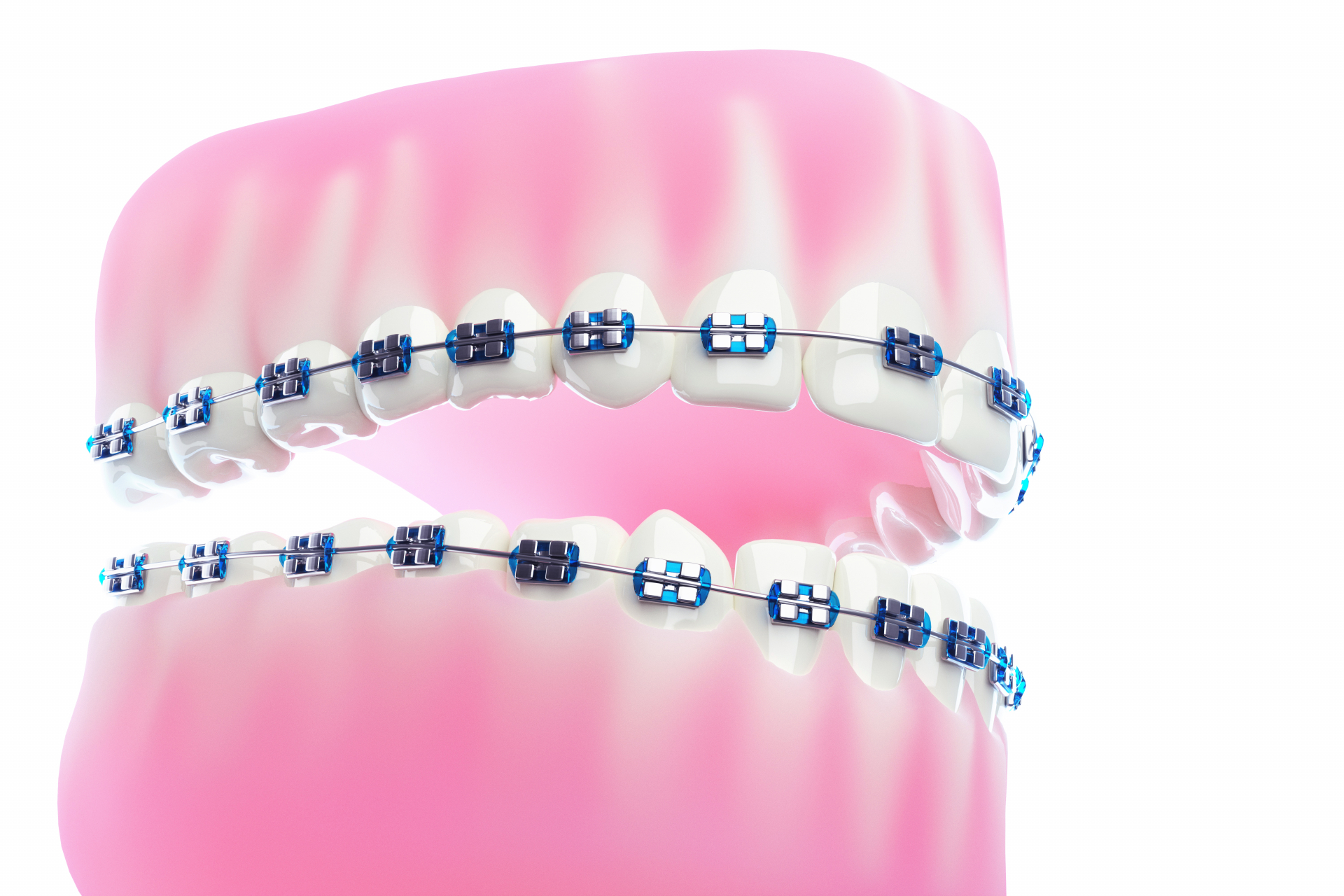 歯科医院で行う歯並びの治療